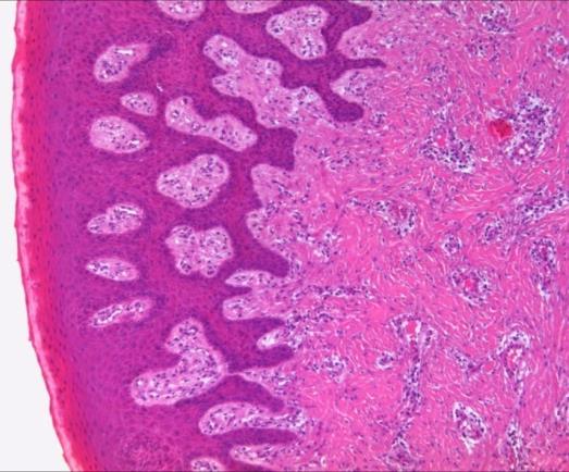 La nivelul corionului în 14 cazuri am observat fibroza subiacentă a epiteliului hiperplaziat constând în prezența de fascicule de fibre de colagen de grosime variabilă