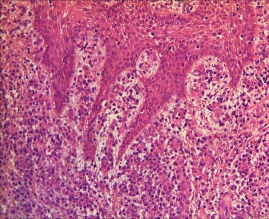 s-a asociat existența unui infiltrat inflamator predominant de tip limfoplasmocitar (Fig. 3.3, Fig. 3.4). Fig. 3.1 Hiperplazie pseudoepiteliomatoasă-creste epiteliale alungite.