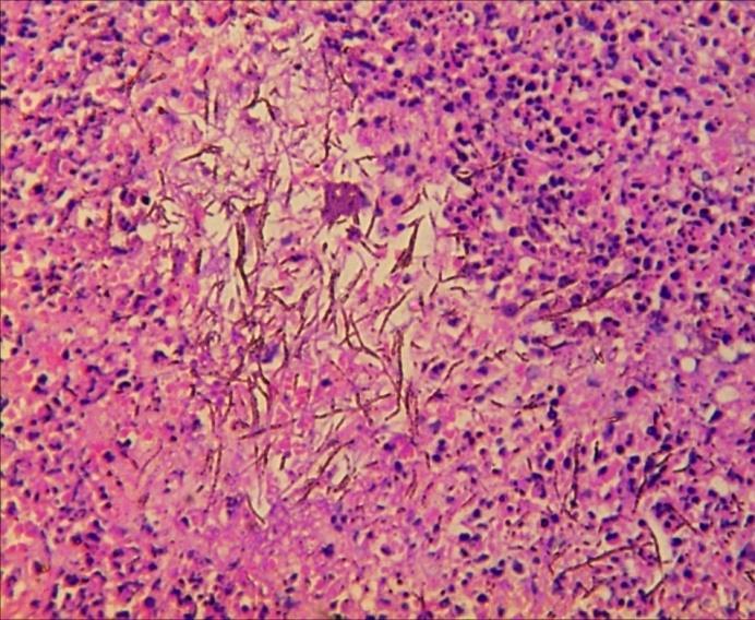 candida (Fig. 3.5, Fig. 3.6, Fig. 3.7).În 7 cazuri hiperplazia orală pseudoepiteliomatoasă s- a asociat cu lichenul plan- Fig. 3.8.