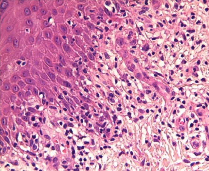 cazuri, urmat de asocierile cu tumora cu celule granulare, diagnosticate în 12,76% din cazuri (Fig. 3.9, Fig. 3.10). Fig. 3.5 HPE asociată tuberculozei-granulom specific tuberculos cu necroză de cazeificare.
