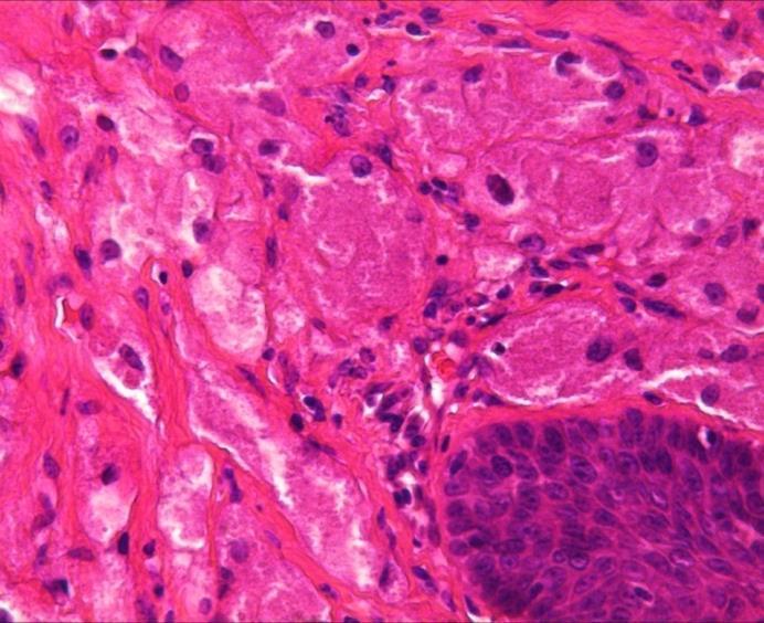 Fig. 3.9 HPE asociată tumorii cu celule granulare. Col HE, x200 Fig. 3.10 HPE şi carcinom scuamos oral bine diferențiat.