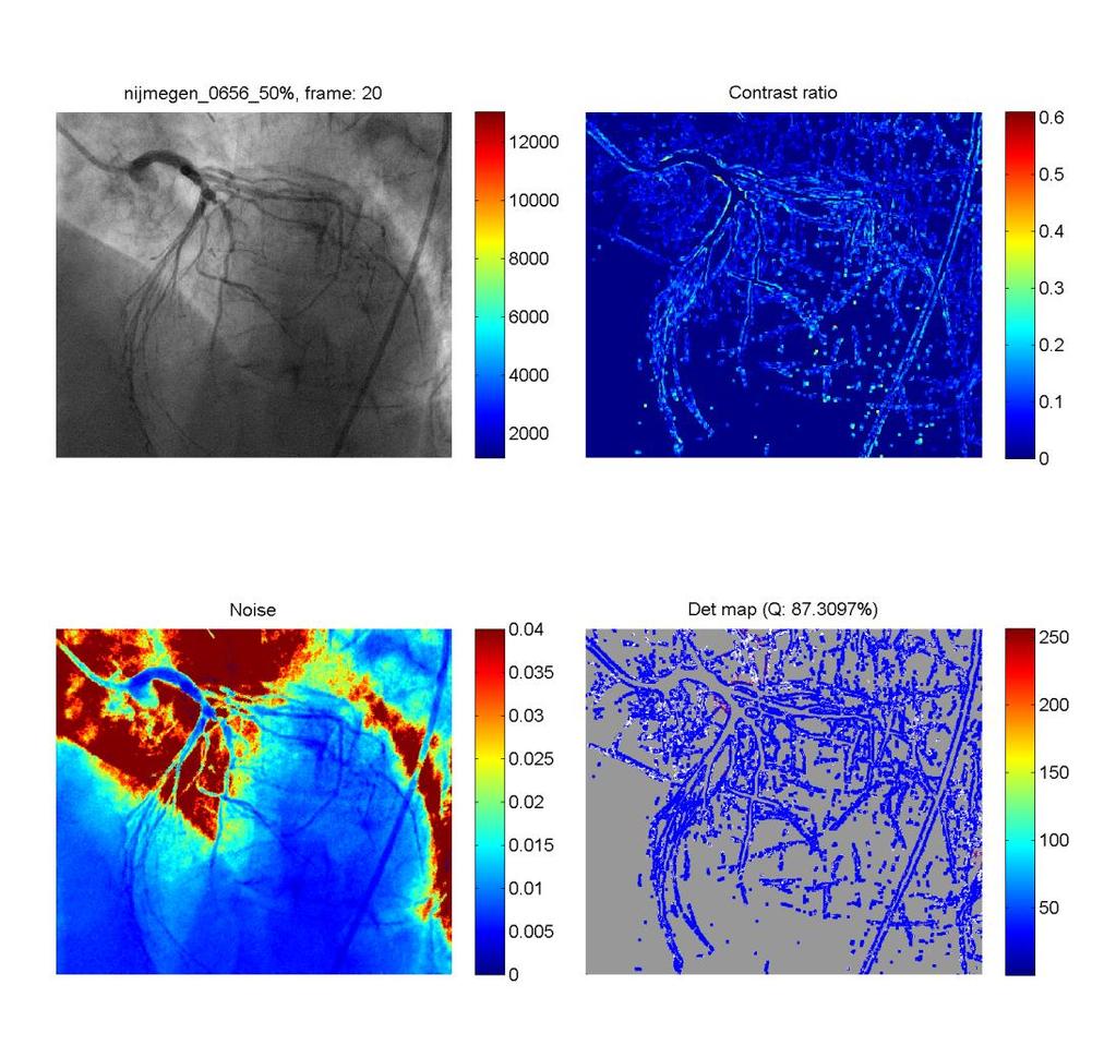 Results interventional cardiology 100% dose 50% dose + denoising Frame Contrast
