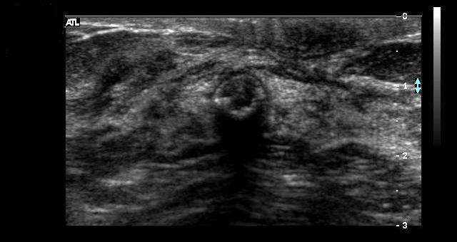 image of breast (Speckle &