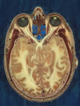 Brain anatomy Visual cortex is where you see Brain damage at this location