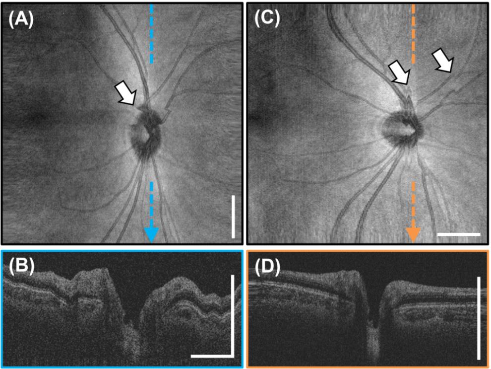 Fig. 4. 6 x 6 mm 2, 1400 x 350 A-scan sinusoidally raster scanned volumes of the optic nerve head acquired in 1.4 seconds each. (A) OCT fundus of the horizontal sinusoidal raster scan.