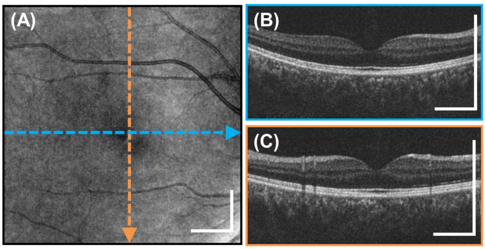 The discontinuous vessel patterns on the fundus image and the region of the repeated scan in the vertical raster volume have been mended. The cross sections in Fig.