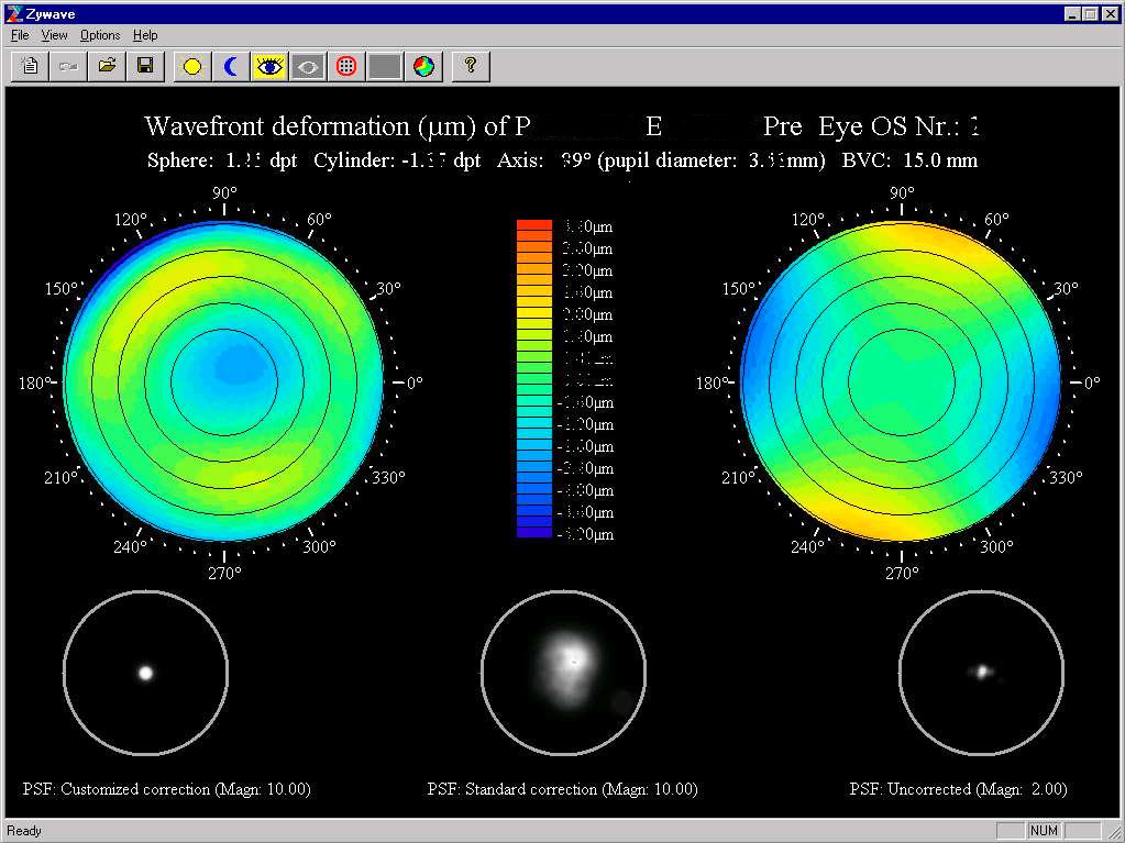 Procedure of spherical aberration reduction through multifocal contact lens fitting Picture 19 shows a spheric contact lens fitting. This spheric contact lens has a power of 2.