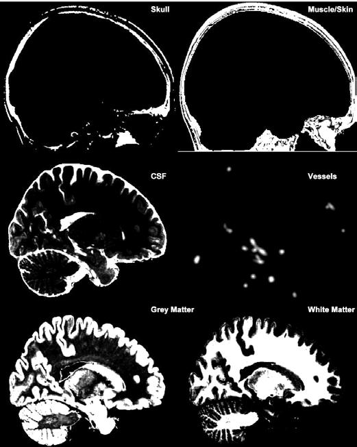 5x0.5 mm) volumes describing content of a voxel McConnell Brain Imaging Centre, Montreal Neurological Institute, McGill University B Aubert-Broche, AC Evans, and DL Collins, A new