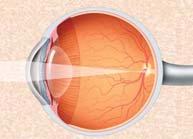 The slight malposition of the crystalline lens as well as of the aspheric IOL contribute to a compensation of coma, the second most