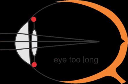 1) The shape of the eye ball 2) The shape of the lens Either of the above produces someone who cannot focus on far targets, is nearsighted, and needs a concave lens.