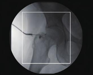 Last Image Hold (LIH) displays the last fluoroscopic image for review without further exposure to the patient.