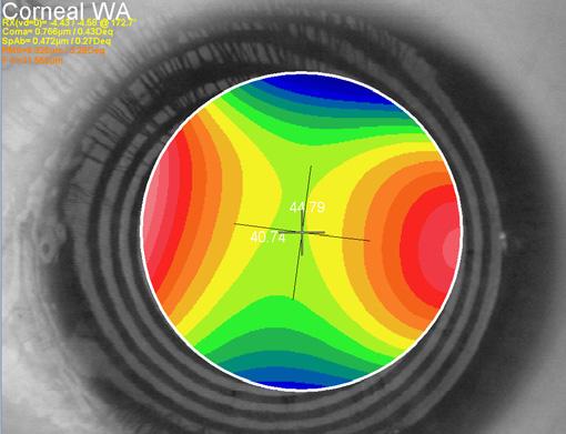 astigmatism. Middle left: 7mm diameter wavefront irregular astigmatism measured at the pupil centre showing 4.