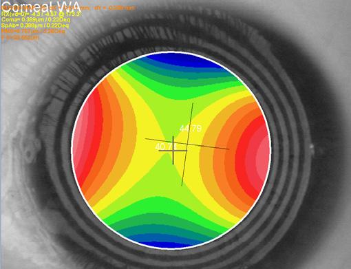 Middle right: 7mm diameter wavefront more regular astigmatism measured at the corneal vertex showing 4.