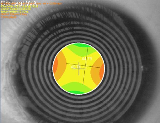 Bottom left: 4mm diameter refractive irregular astigmatism measured at the pupil centre showing 4.