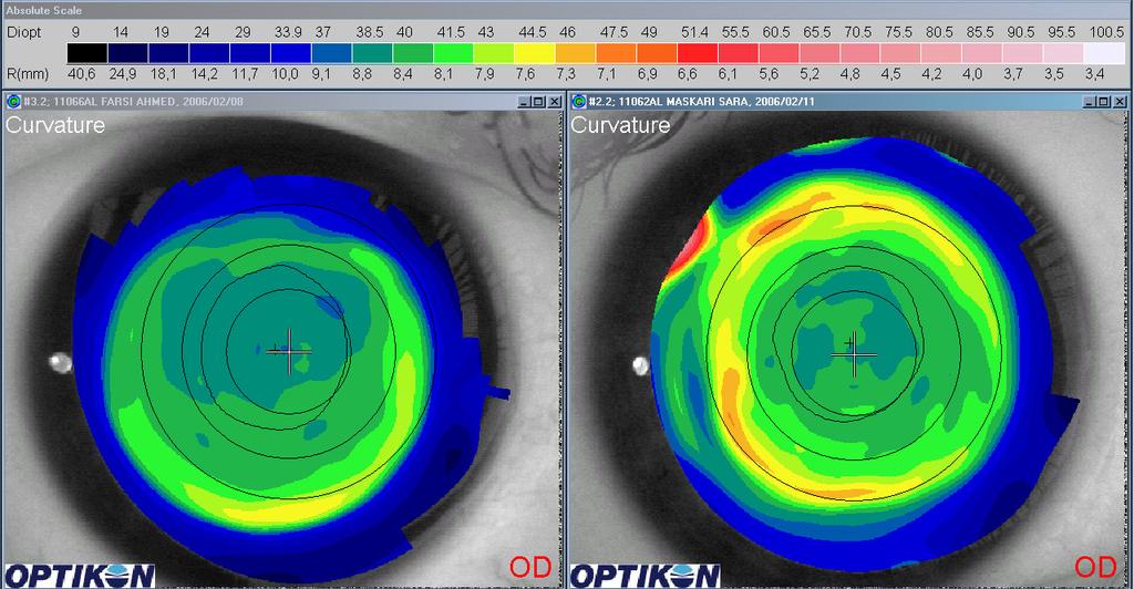 34 Astigmatism Optics, Physiology and Management Fig. 14. Comparison of topographical findings after centration at the pupil centre and corneal vertex, respectively.