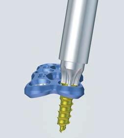 Implant removal 1 Clean screw head Required instruments 324.