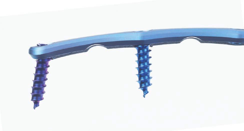 Vectra. The flexible and easy-to-use anterior cervical plate system. Plates Integrated blocking mechanism Prelordosed Large graft visibility window 16.5 mm wide and 2.