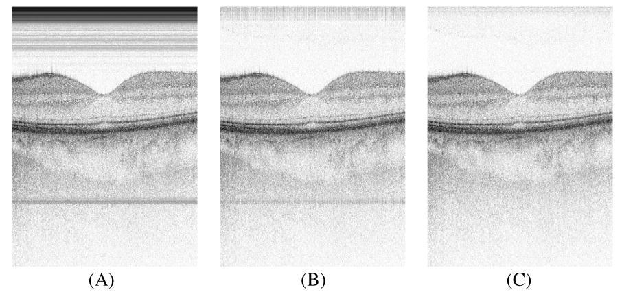 5.1 Fixed-pattern noise removal In Fig. 6 the effect of fixed-pattern noise removal is shown in an intensity image of the macula of a healthy volunteer. The image has a width of 4.