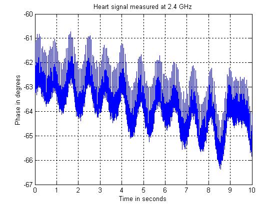 Figure 1 Heart activity detected at 2.4 GHz and 1 m from the patient II.2 Separation of heart beat and breathing II.2.1 Introduction: In the Doppler radar cardiopulmonary motion monitoring system, the heartbeat and respiration signals are superimposed on each other (figure 2).