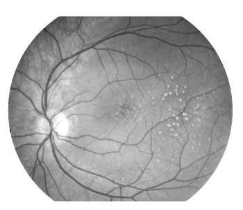 appear similar to normal features of the retina, such as the background pattern caused by the choroidal vessels. Figure 1 shows two examples of images 1 containing drusen.