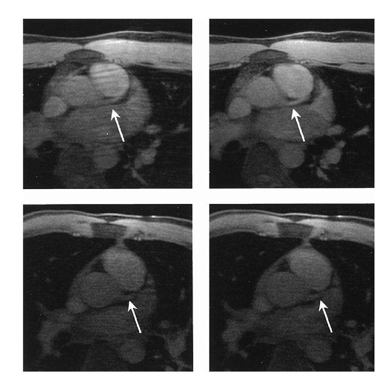 Du et al. Page 7 Figure 1. Images acquired with retrospective gating (left) and prospective gating (right) in a section near the origin of the LM coronary artery from two subjects.