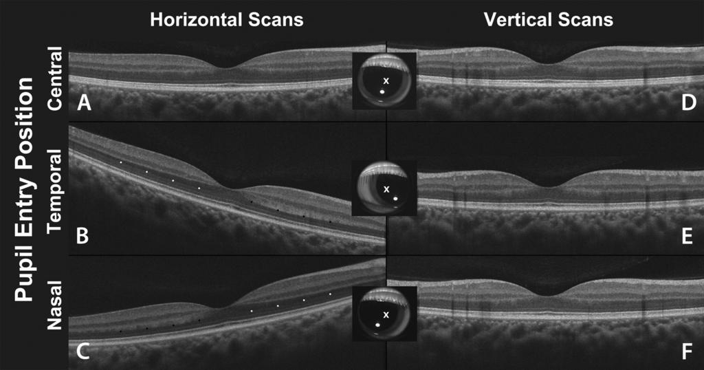 1488 Lujan et al. IOVS, March 2011, Vol. 52, No. 3 FIGURE 2. The effects of horizontally varying pupil entry position on horizontal and vertical B-scans in a right eye.