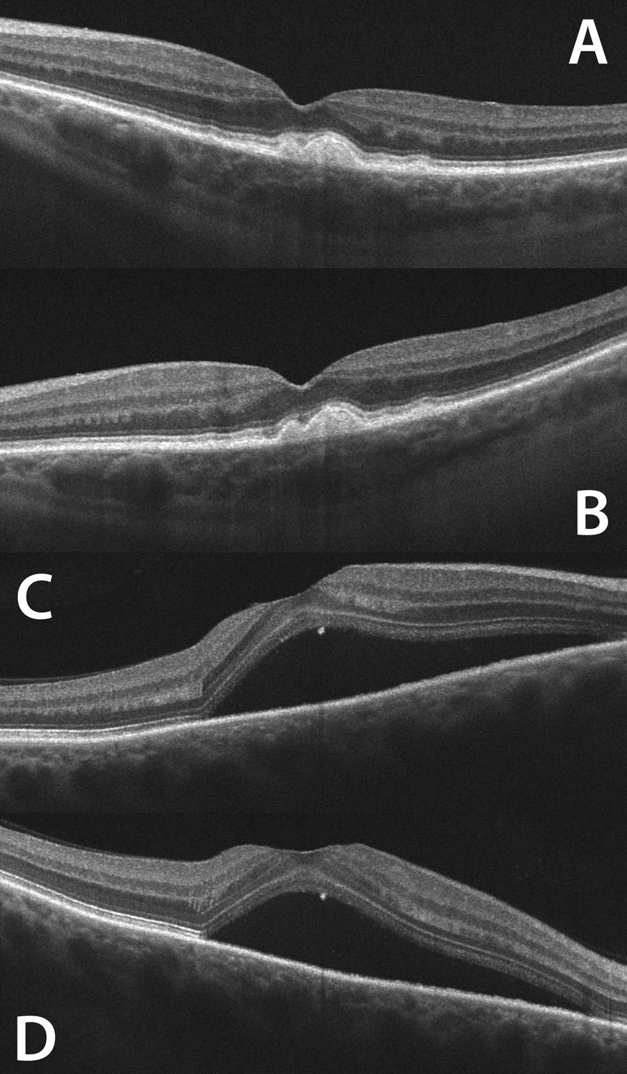 1490 Lujan et al. IOVS, March 2011, Vol. 52, No. 3 FIGURE 5. Clinical visualization of reflectivity changes in HFL. (A) Central serous chorioretinopathy.