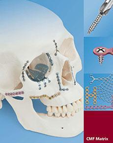 fractures using implants and
