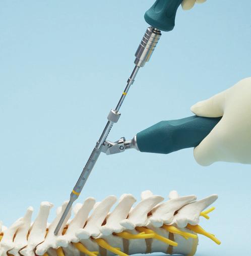 Use the feeler to confirm, by palpation, accurate placement within the pedicle or lateral mass. Note: Perform drilling in steps until the appropriate depth is reached. Alternative instruments 03.614.