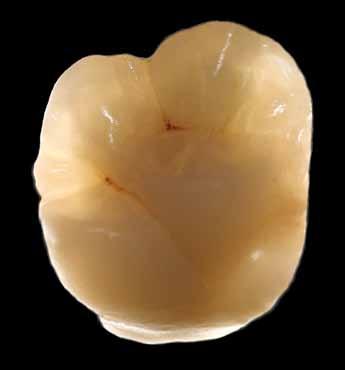 or spread by the opaquer, but already in the dentine layer. Natural teeth have a binary structure consisting of dentine and enamel.