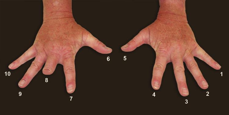 Taking a Set of Fingerprints Figure 2-14. Finger numbering when finger is missing 2-21. Cuts, scratches, blisters, and wounds fall in the category of temporary disabilities.