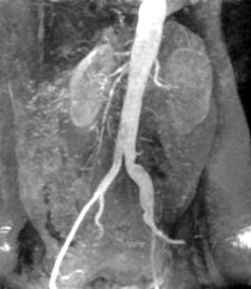 Contrast Enhancement radiography Aortic angiogram A catheter is inserted in a blood vessel to be
