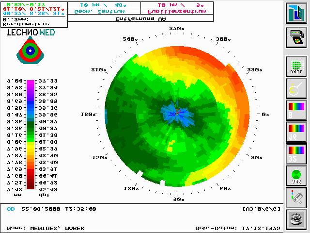 Ablation profiles Total wavefront Wavefront of higher orders Pre-OP Post-OP 6 months vertical axis [mm]