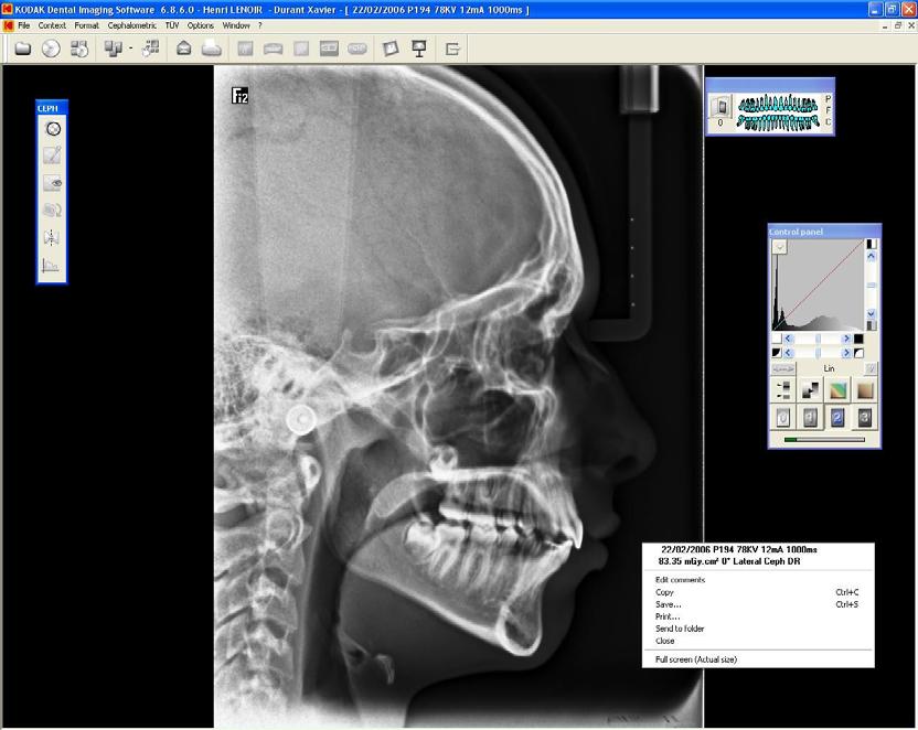 X-Ray Dose Emission Information X-Ray Dose Emission Information Compliance with EURATOM 97/43 Directive You can right-click on each image to display the estimated emitted dose received by the patient.