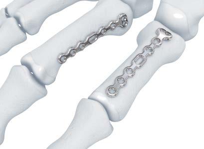Featured Plates & Technique Highlights Phalangeal Base Plate Designed with an anatomic contour and hole configuration to facilitate fixation of fractures at the base of the middle and proximal