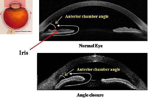 ANTERIOR CHAMBER ANGLE MEASUREMENT USING OPTICAL COHERENCE TOMOGRAPHY IMAGE M.Prabha Mr.A.Rajan ME-Applied Electronics Assistant Professor (Sr)/ECE Shri Andal Alagar College of Engineering Shri Andal