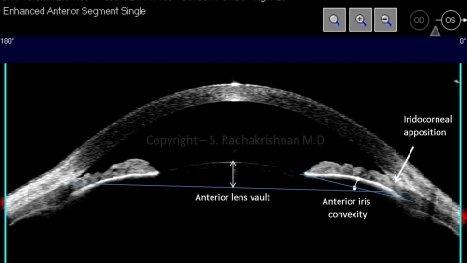 1.1 Qualitative assessment An important landmark to identify when interpreting ASOCT images is the scleral spur.