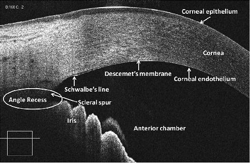 ASOCT uses the principle of low-coherence interferometry instead of ultrasound to produce high-resolution, cross sectional images of the anterior segment of the eye.