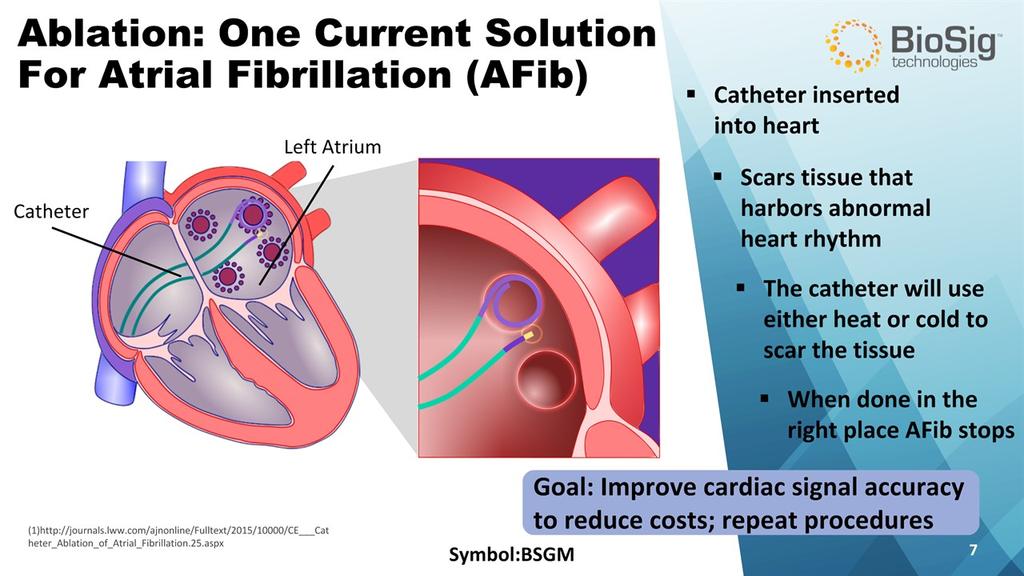 Goal: Improve cardiac signal accuracy to reduce costs; repeat procedures Symbol:BSGM * Ablation: One Current SolutionFor Atrial Fibrillation (AFib) Catheter inserted into heart Scars tissue that