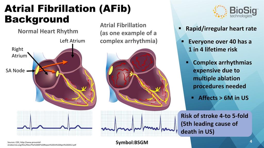 Risk of stroke 4-to 5-fold(5th leading cause of death in US) Symbol:BSGM * Atrial Fibrillation (AFib)Background Normal Heart Rhythm Atrial Fibrillation (as one example of acomplex arrhythmia)