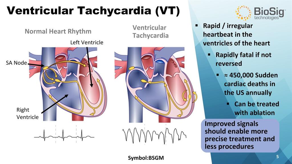 Improved signals should enable more precise treatment and less procedures Ventricular Tachycardia (VT) Symbol:BSGM * Normal Heart Rhythm VentricularTachycardia 450,000 Sudden cardiac