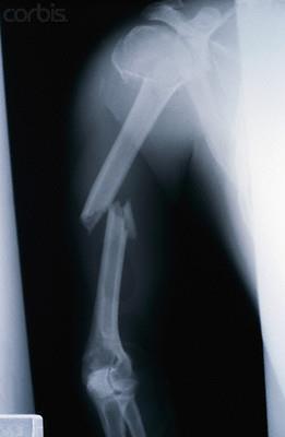 X-Rays X-Rays are used in medicine,