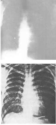 Example: an x-ray An original x-ray image