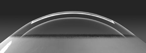 ifs 150 khz IntraLase Technology Inverted Bevel-In Side Cut Angle: Provides better wound healing for enhanced biomechanical stability of the post LASIK cornea 1,2 Increased flap adhesion