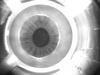 in the cornea.