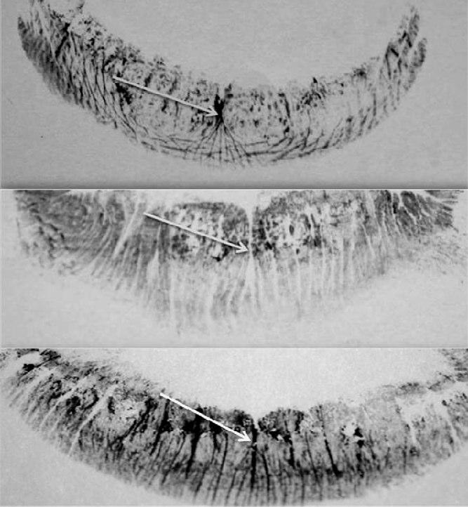Photographs of lower lip prints of three Saudi individuals the same groove types