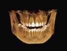 Implant Orthodontic surgery 7.