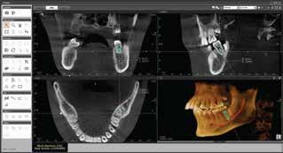 in 3D printers and models - intraoral scanners Image