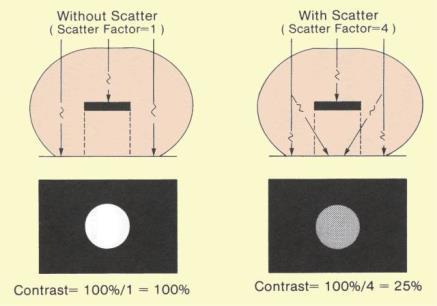 Use of grids also help with the contrast by removing scatter radiation. Remember the wide dynamic range?