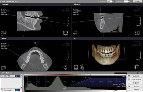 [Sample Image from FOV 12*7: Capturing Mode Mandibular] Standard Examination Programs In each program the compensation for the spinal column is